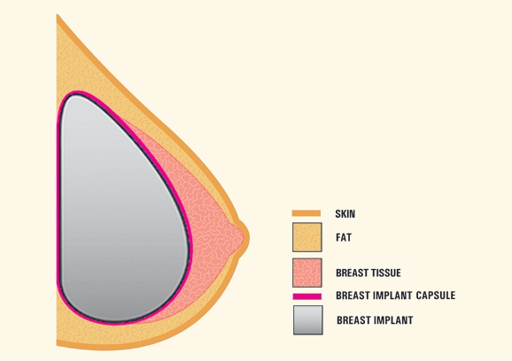Esquema. Implante mamario-Cápsula periprotésica.