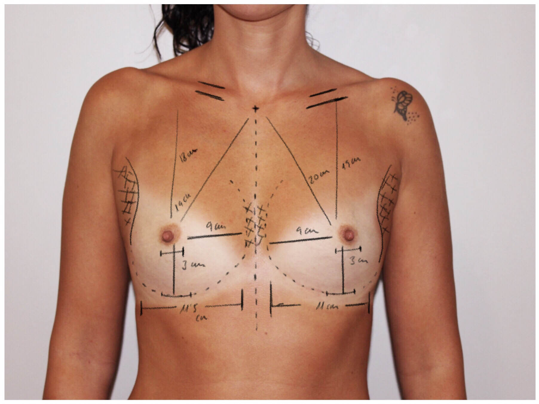 Curso cirugia de mama, pecho y contorno corporal