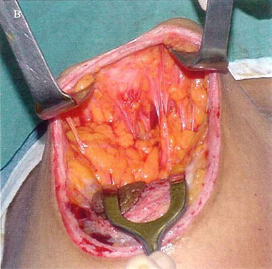 Mastopexia sin implantes