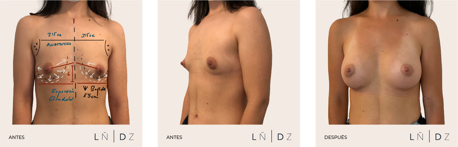Antes y después corrección mama tuberosa