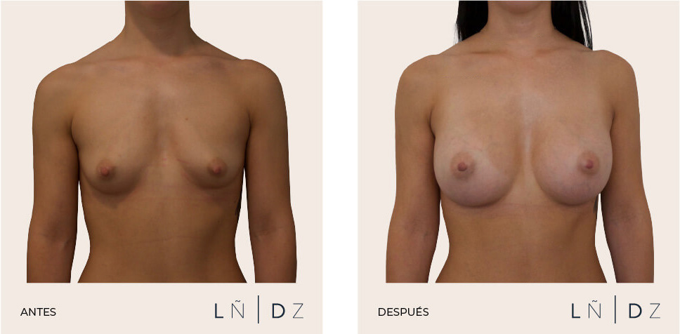 Antes y después aumento de mama
