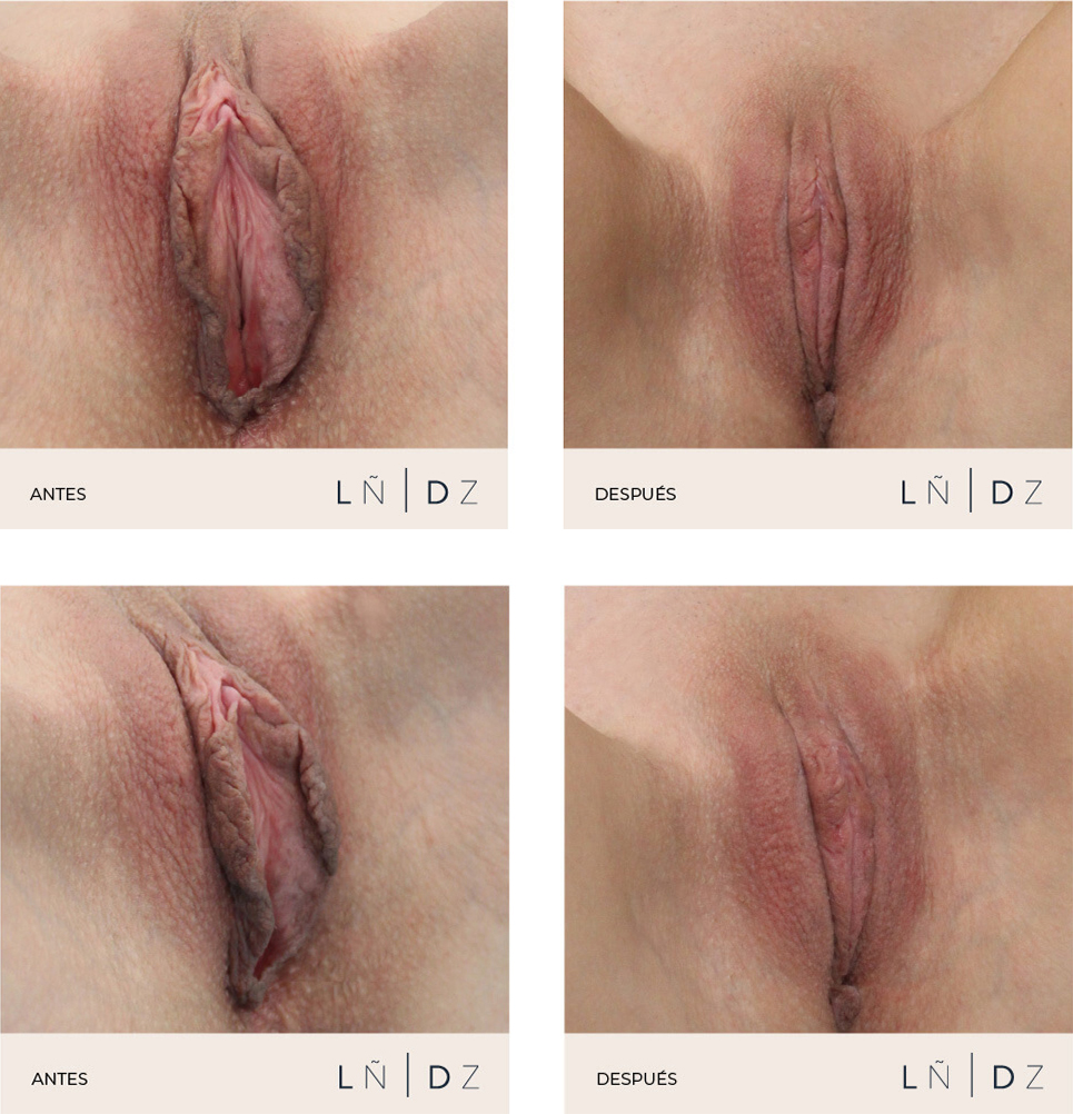 Antes y después labioplastia