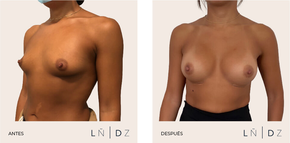 Antes y después corrección mama tuberosa